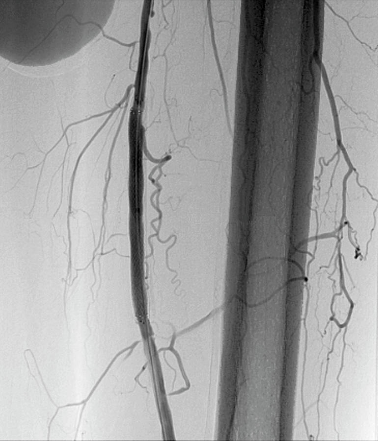 Stent In A Femoral Artery Photograph by Zephyr/science Photo Library ...