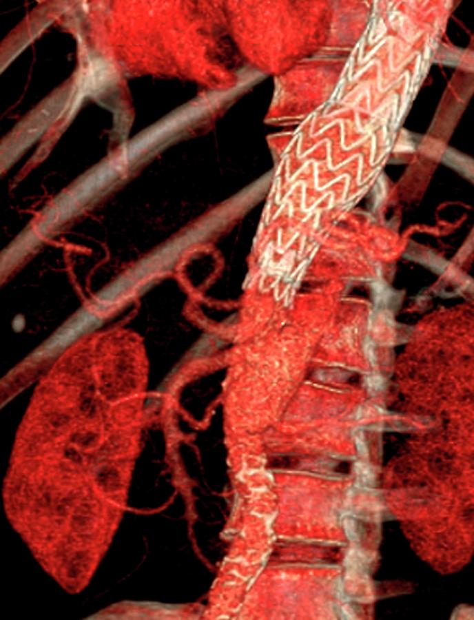 Stent In Aortic Dissection Photograph by Zephyr/science Photo Library