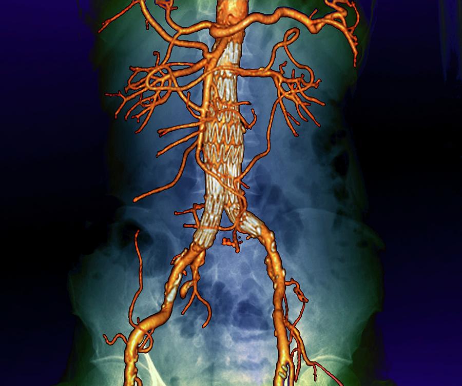 Stent In The Abdominal Aorta Photograph by Zephyr/science Photo Library