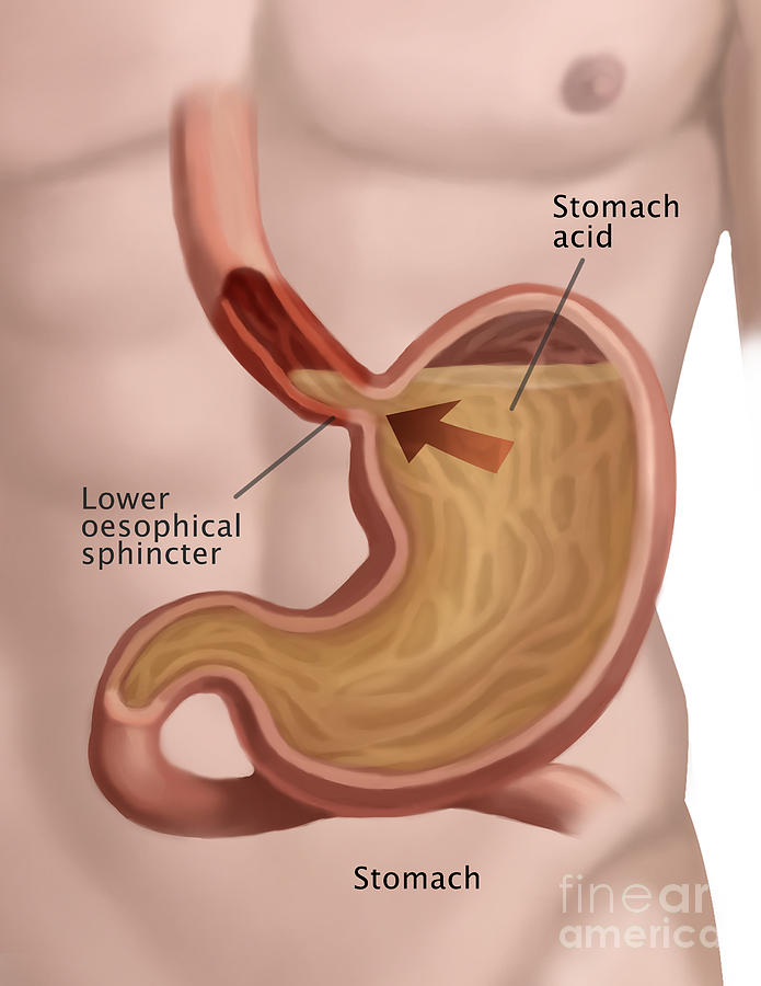 Stomach Acid Reflux Photograph by Spencer Sutton