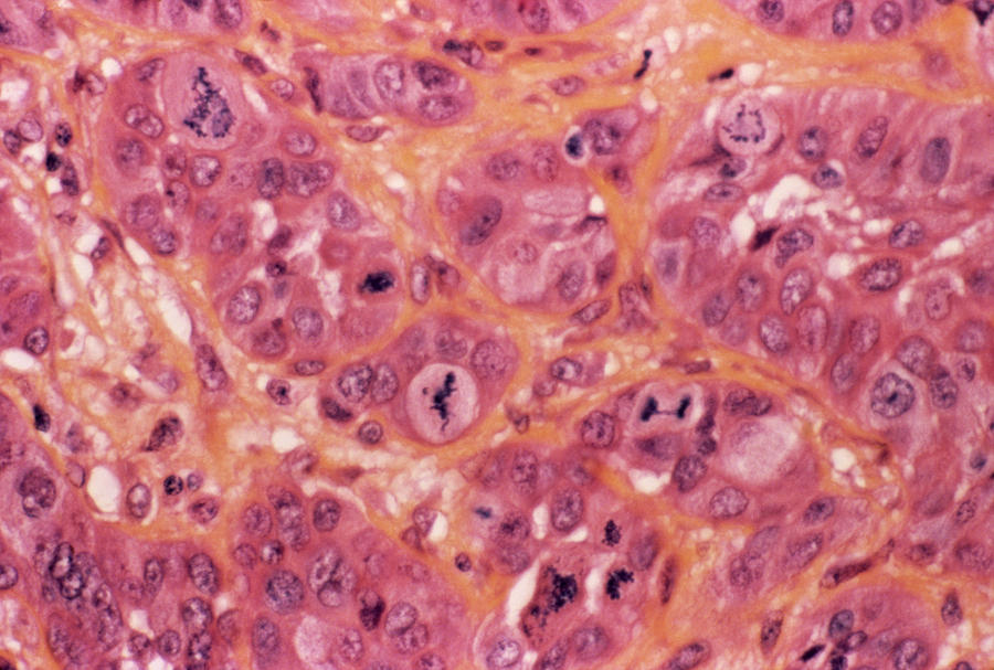 Adenocarcinoma Photograph - Stomach Cancer by Cnri/science Photo Library