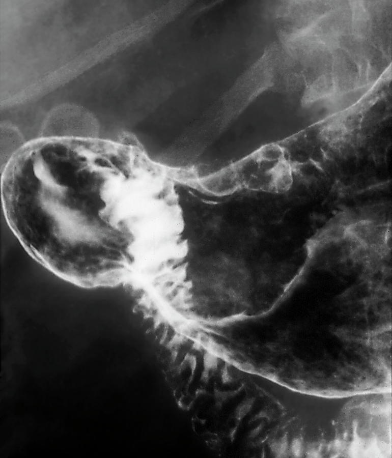 Stomach Cancer Photograph by Zephyr/science Photo Library