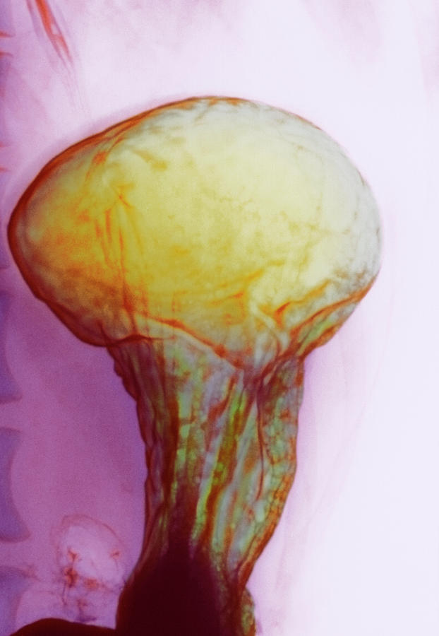 Stomach Photograph by Cnri/science Photo Library