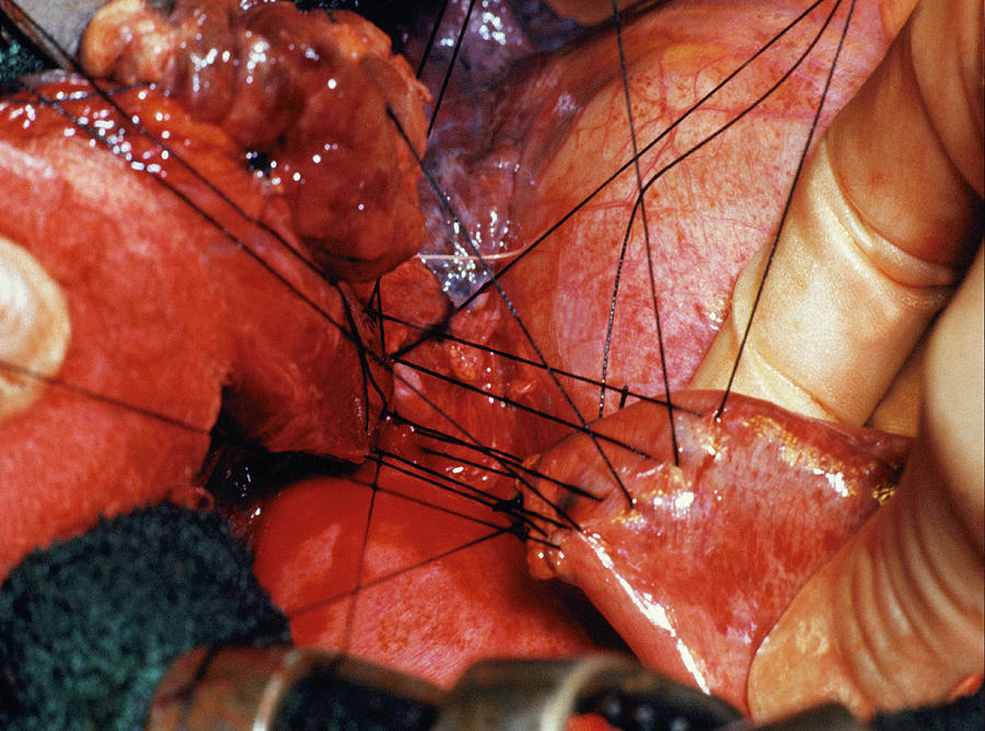 Stomach Hernia Operation Photograph By Steve Allenscience Photo Library