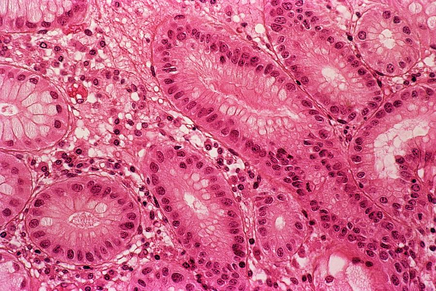 Stomach Metaplasia Photograph by Cnri/science Photo Library - Pixels