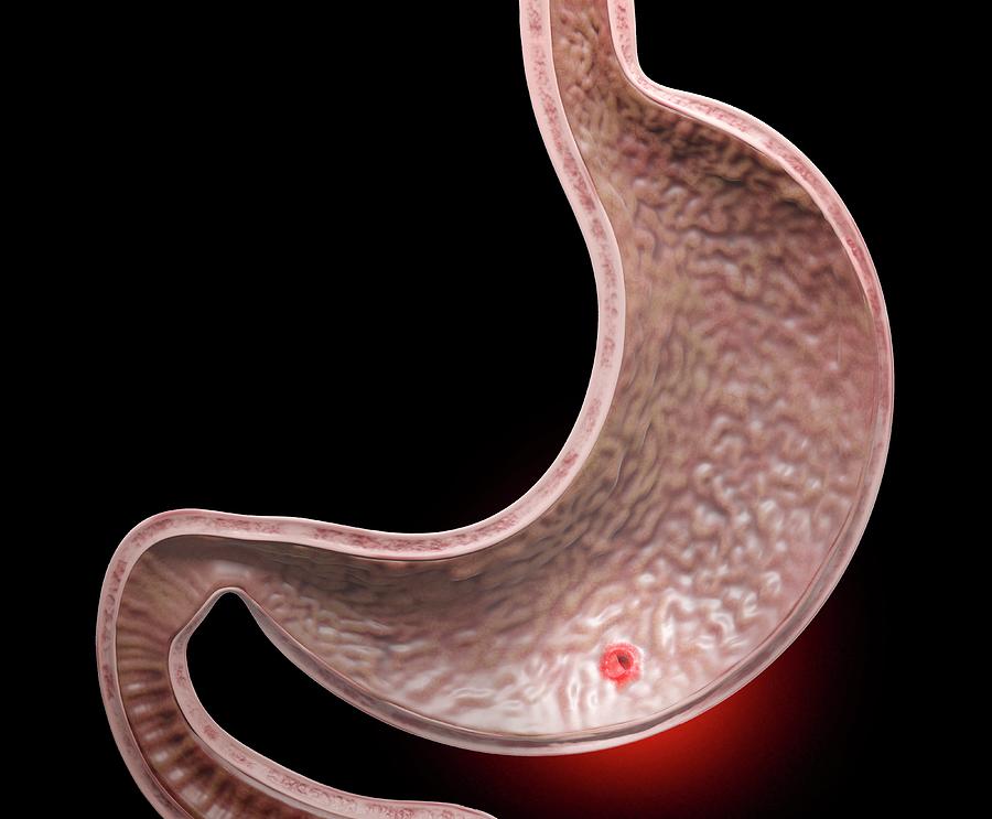 Stomach Ulcer Photograph by Tim Vernon / Science Photo Library - Fine ...