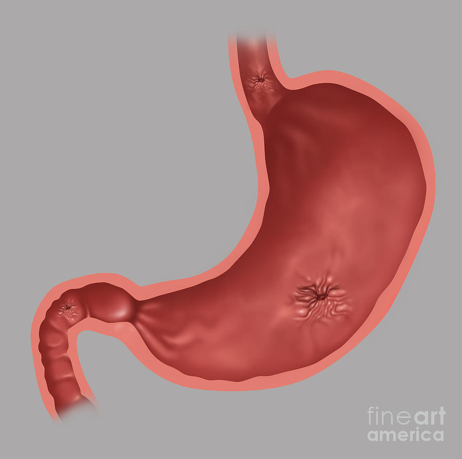 Illustration Photograph - Stomach Ulcers, Illustration by Gwen Shockey