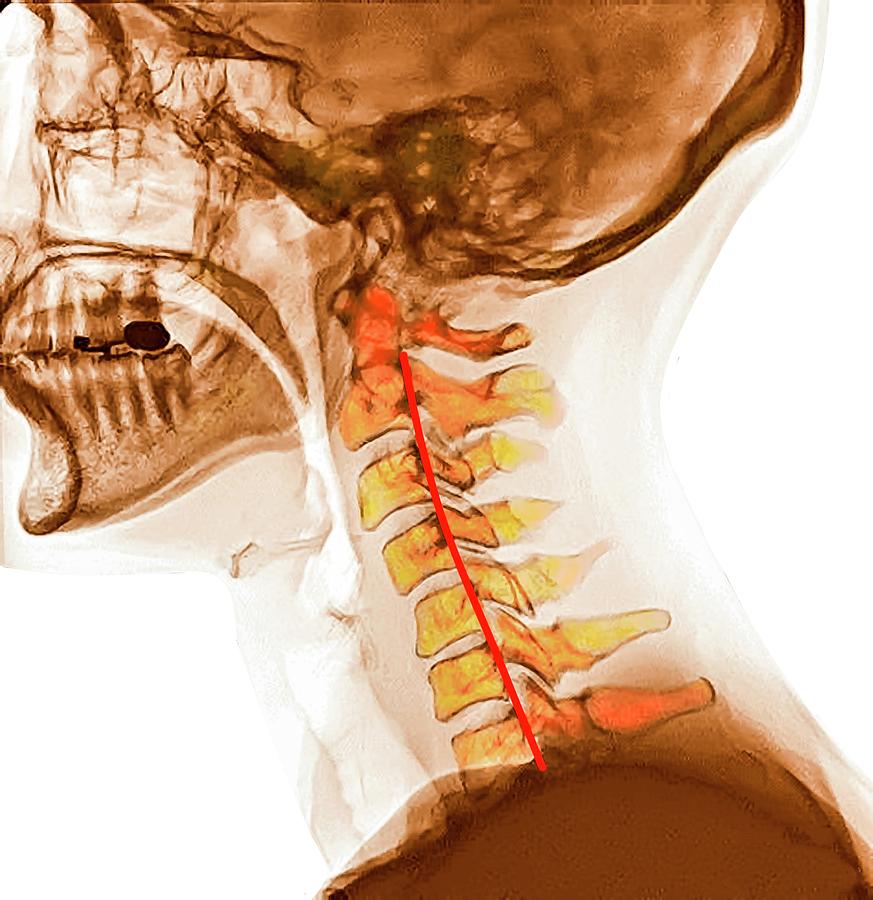 Straightened Neck Curvature Photograph by Medical Media Images ...