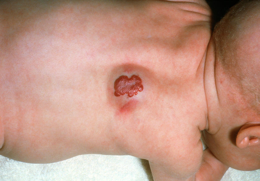 Strawberry Naevus On The Back Of A Baby Photograph by Mike Devlin