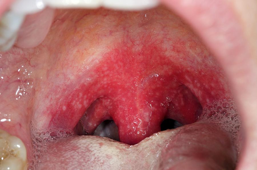 Strep B Throat Infection Photograph By Dr P Marazziscience Photo Library