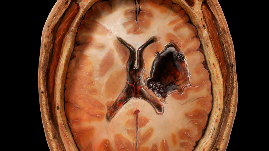 Stroke, Brain Photograph by Anatomical Travelogue