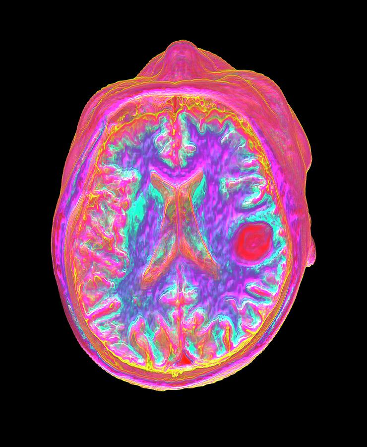 Stroke Due To Blood Clot Photograph by K H Fung/science Photo Library