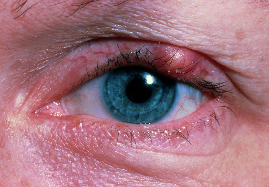 Hordeolum Or Stye On The Upper Eyelid Photograph By Science Photo Library My Xxx Hot Girl