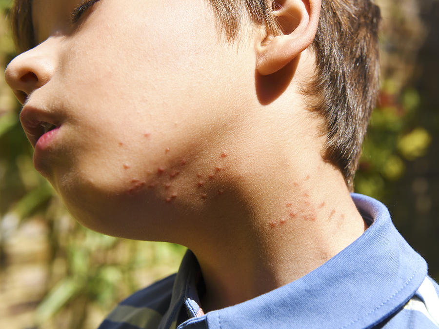 Summer insect bites on boys neck Photograph by Peter Dazeley