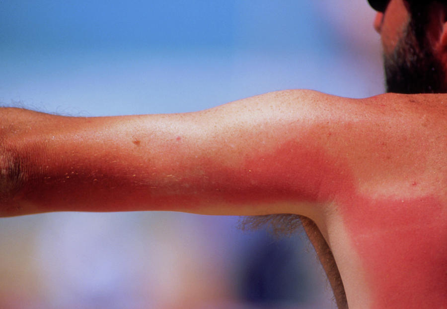 Sunburn On Mans Back And Arm Photograph By Sinclair Stammersscience