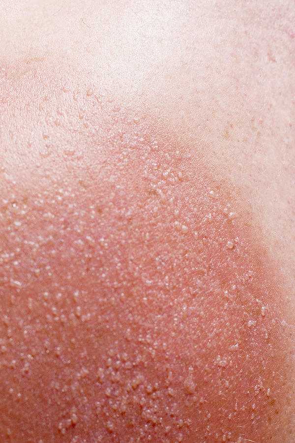 Sunburned skin on mans shoulders, close-up Photograph by Ian Hooton/spl