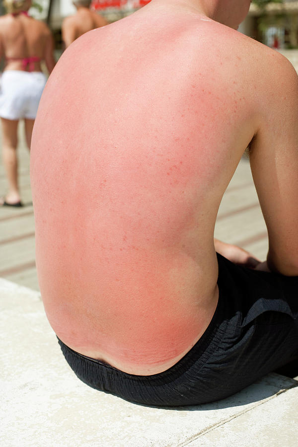 Sunburnt Skin Photograph by Ian Hooton/science Photo Library