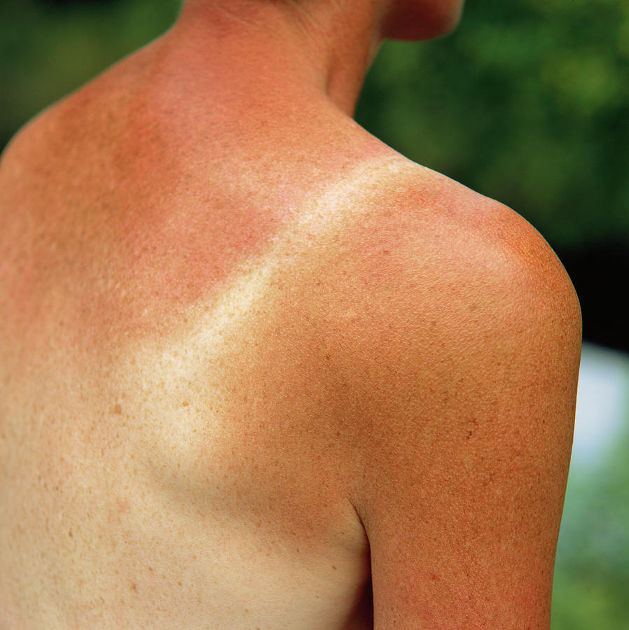 Sunburnt Skin Photograph By Sheila Terryscience Photo Library Fine