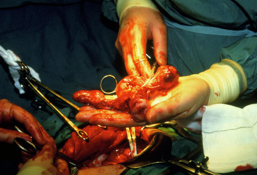 Surgeon Holding Woman's Uterus After Hysterectomy Photograph by Antonia