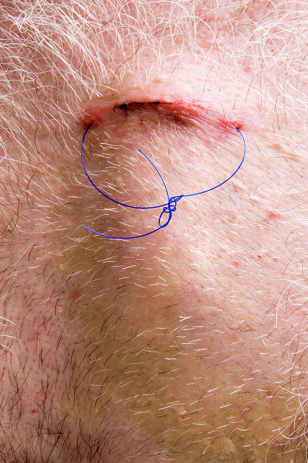 Device Photograph - Sutured Surgical Incision by Sheila Terry/science Photo Library