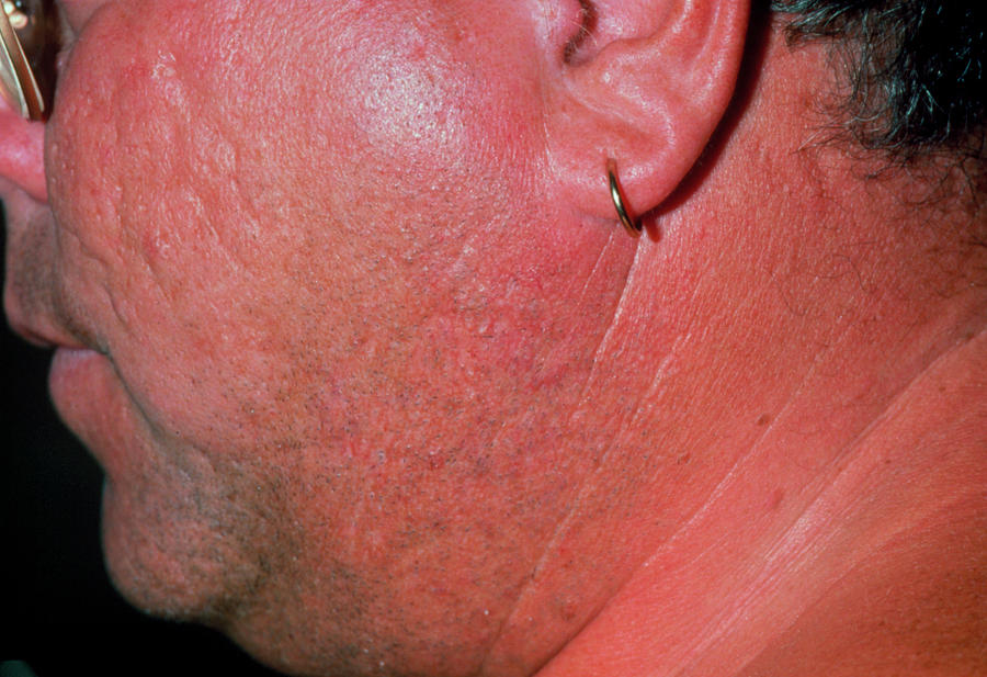 Swelling Of Glands In Man With Mumps Photograph By Dr P Marazzi Science Photo Library