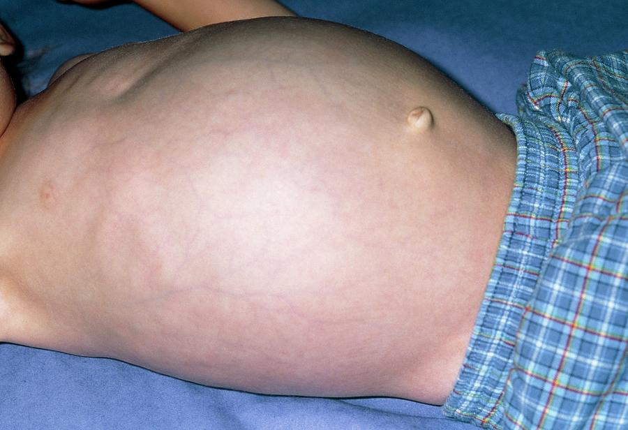Swollen Abdomen Due To Hepatomegaly From Cancer Photograph By Dr P 