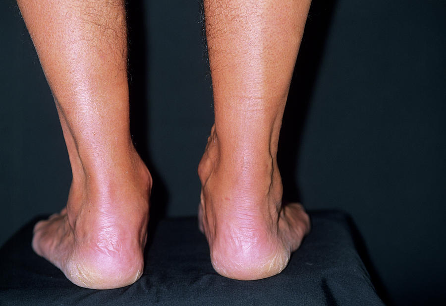 Swollen Achilles Tendon Photograph by Dr P. Marazzi/science Photo Library