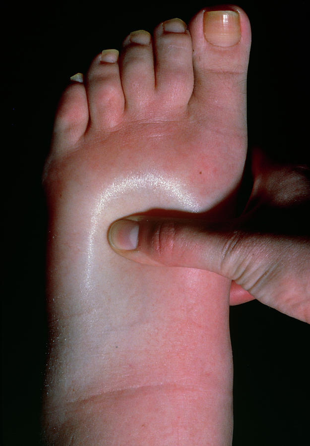 Swollen Foot Showing Pitting Oedema. Photograph by Science Photo Library