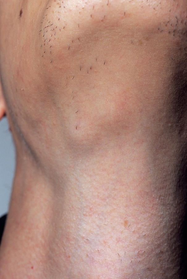 enlarged lymph node back of neck