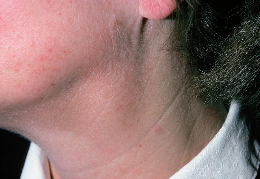 enlarged lymph nodes on back of head