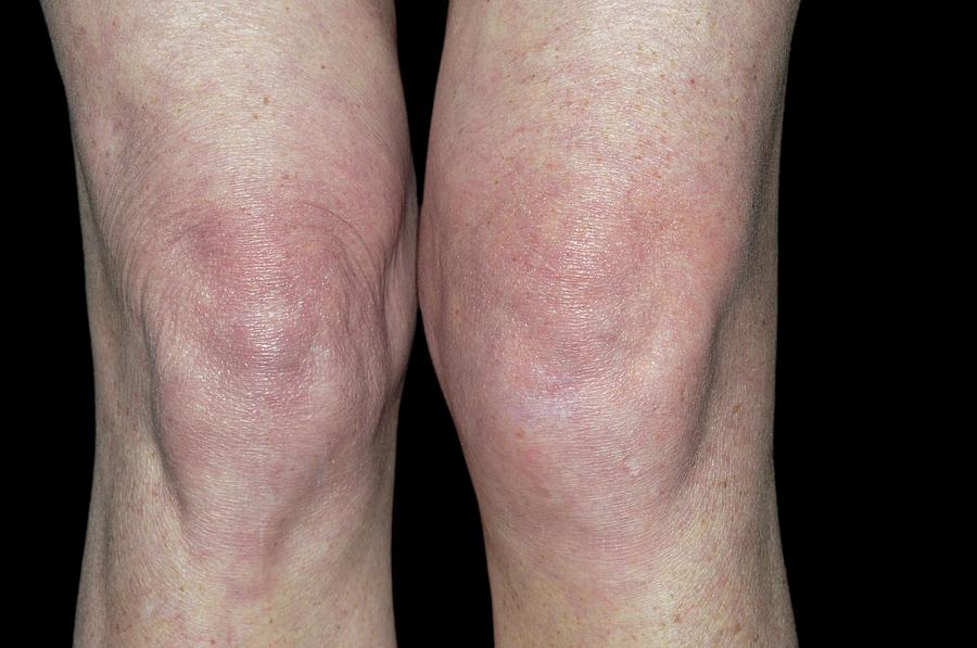 swollen-joint-of-the-knee-after-a-fall-photograph-by-dr-p-marazzi