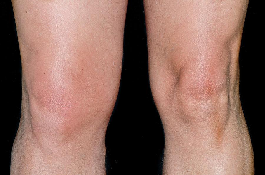 swollen-knee-from-torn-ligament-photograph-by-dr-p-marazzi-science