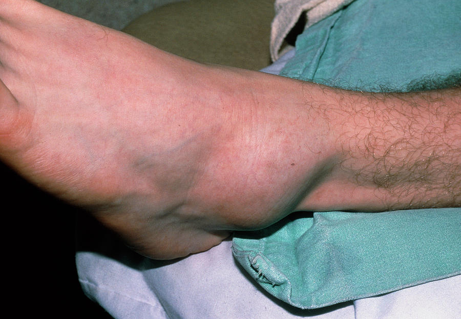 swollen-left-ankle-due-to-sprain-photograph-by-science-photo-library