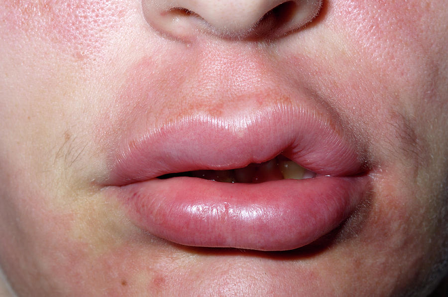 Swollen Lip Photograph By Dr P Marazziscience Photo Library 7770