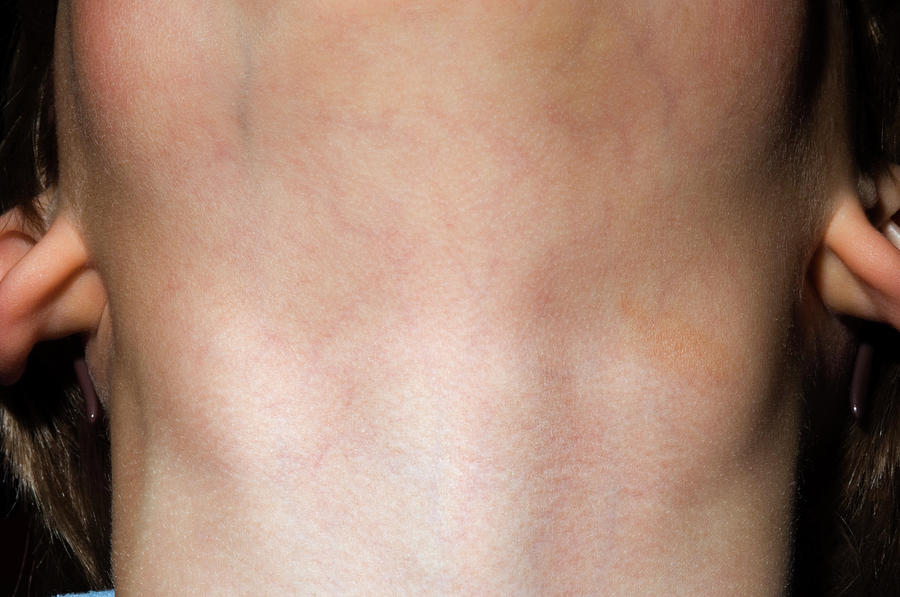enlarged lymph nodes in neck