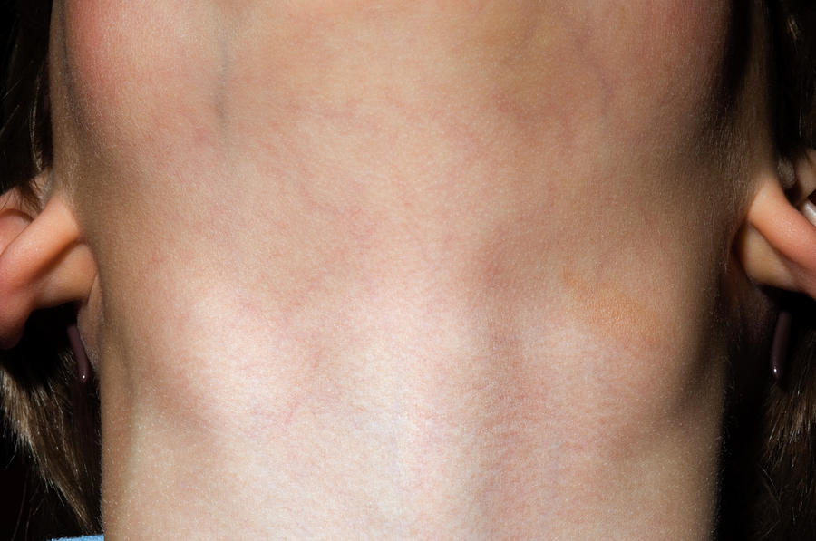 Swollen Lymph Glands In Neck Photograph By Dr P Marazziscience Photo