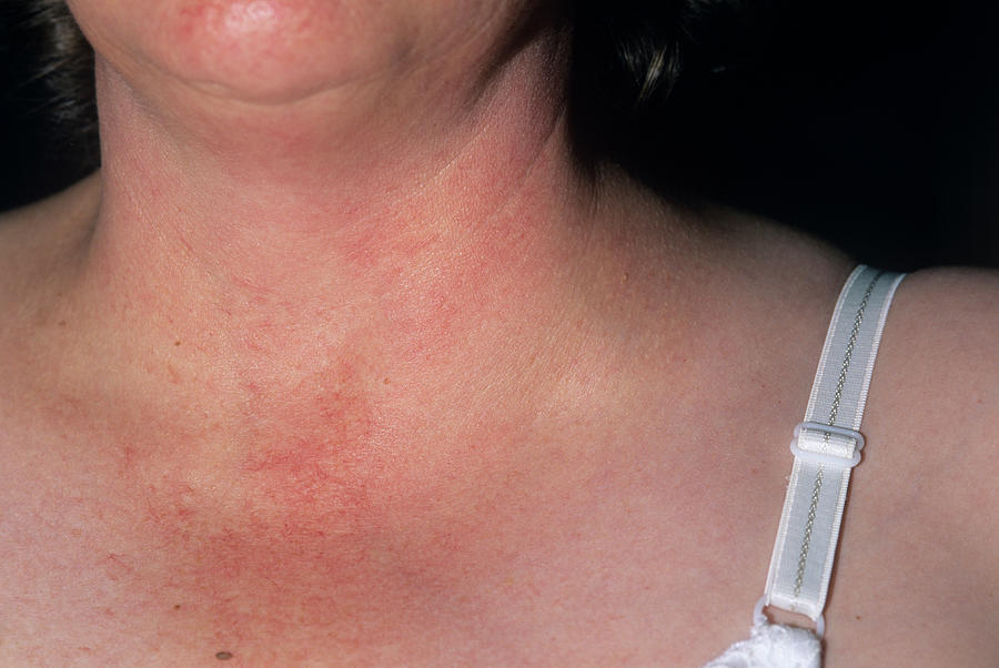 swollen neck lymph nodes