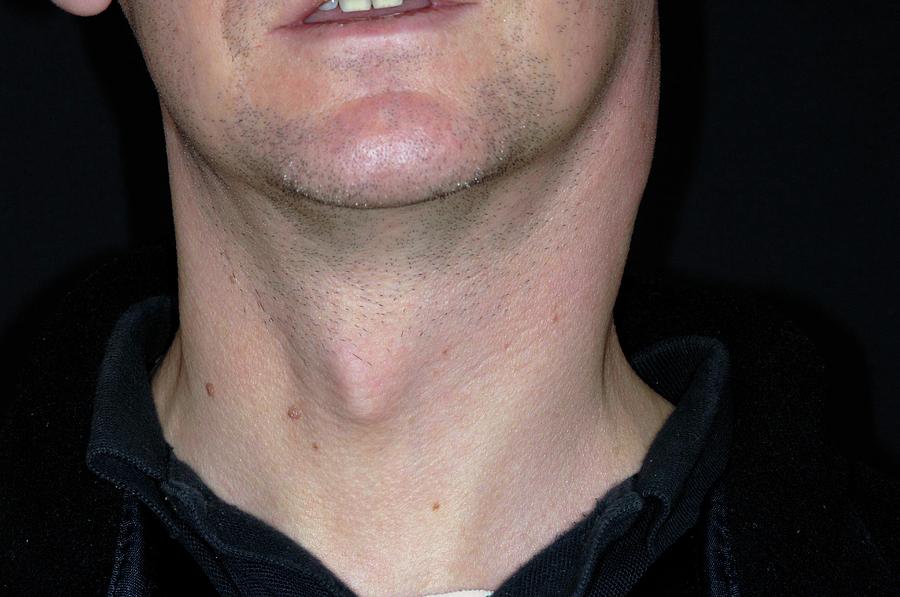 Swollen Lymph Nodes In Tonsillitis Photograph By Dr P Marazziscience