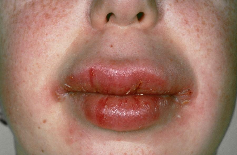 Swollen Mouth In Crohn's Disease Photograph by St Bartholomew Hospital