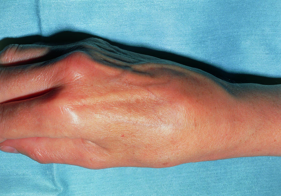 swollen-right-hand-due-to-osteoarthritis-in-wrist-photograph-by-science