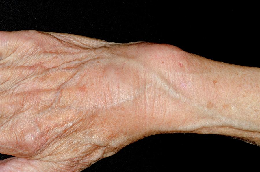 Swollen Sprained Wrist Photograph By Dr P Marazzi Science Photo Library