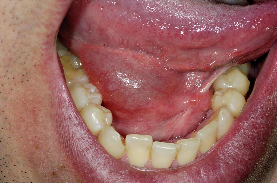 Swollen Sublingual Salivary Gland Photograph By Dr P.