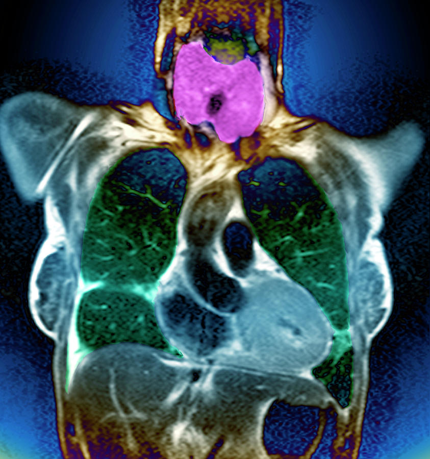 Swollen Thyroid Gland Photograph By Zephyrscience Photo Library