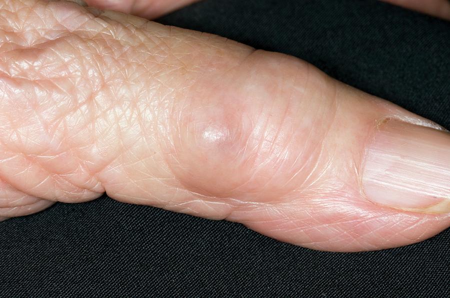 Synovial Cyst On The Finger Photograph By Dr P Marazzi Science Photo Library