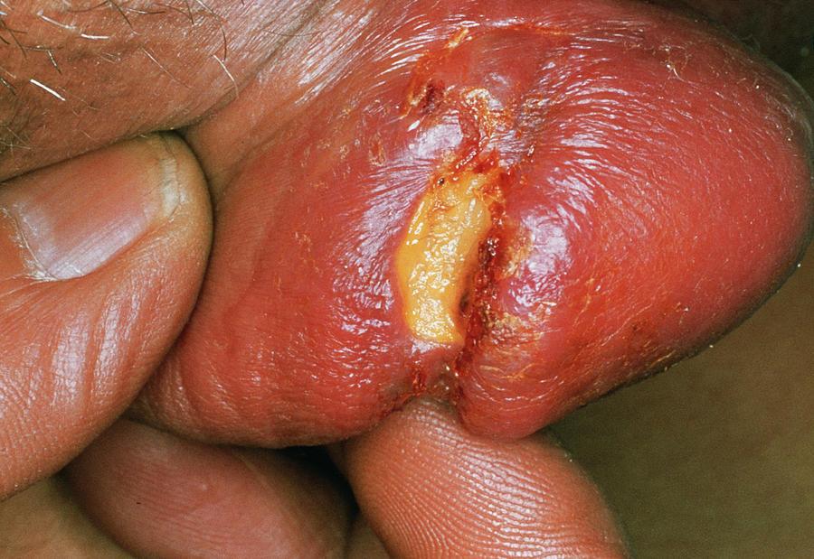 Syphilis Photograph - Syphilis Chancre On Penis by Cnri/science Photo Library