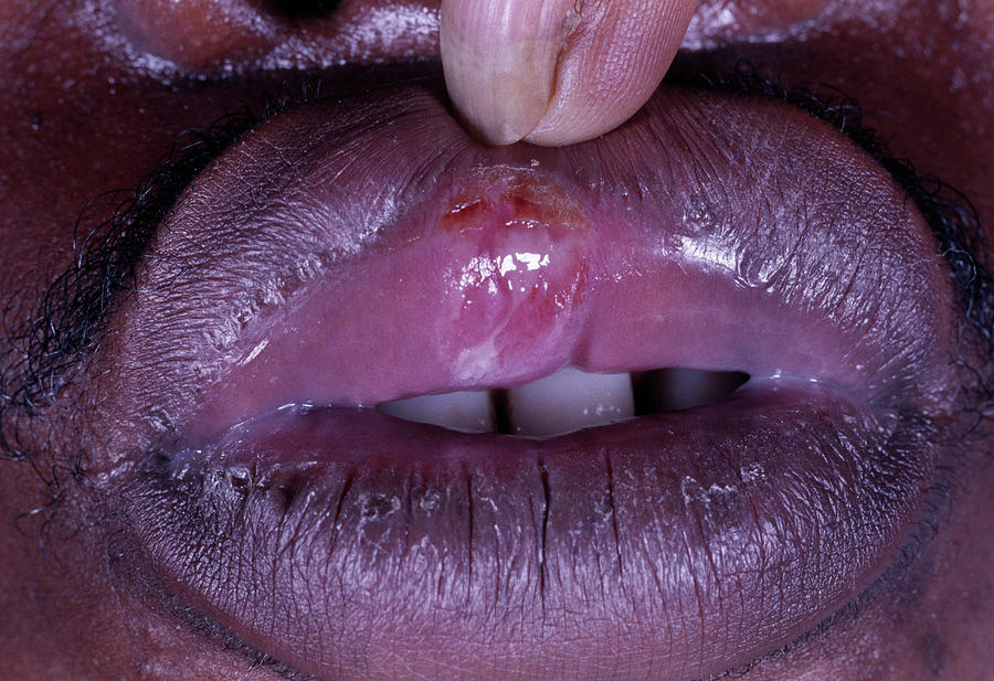 Syphilis Lip Ulcer Photograph by Dr M.a. Ansary/science Photo Library