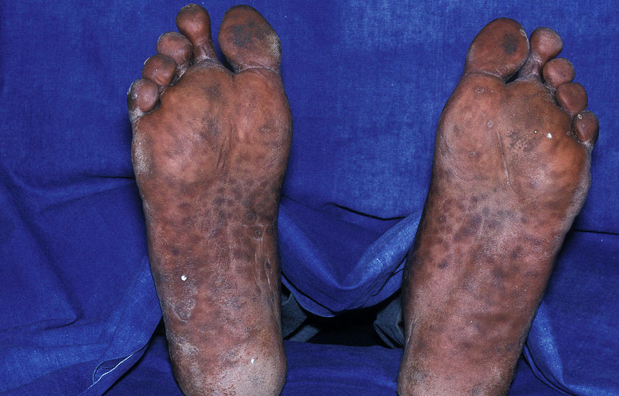 Syphilis Rash Photograph by Dr M.a. Ansary/science Photo Library