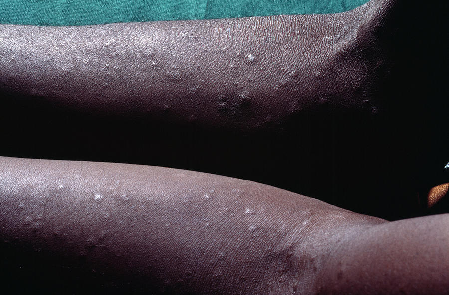 Syphilis Rash In An Aids Patient Photograph by Dr M.a. Ansary/science Photo Library