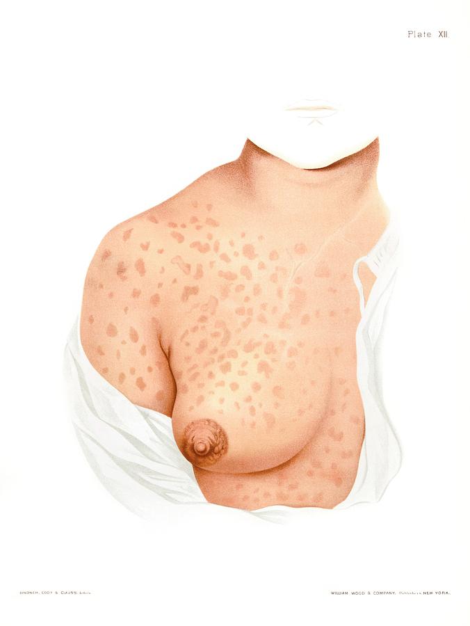 std skin rash on chest