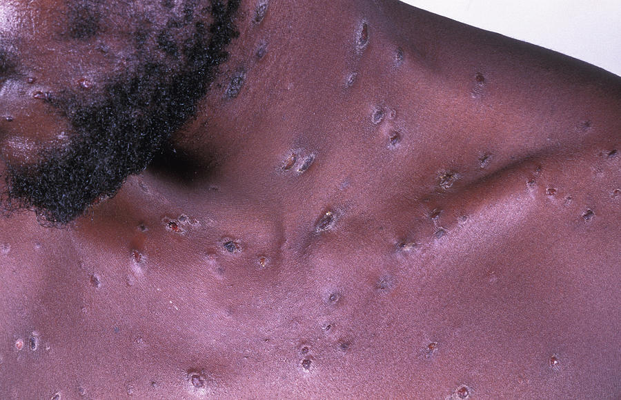 Syphilis Skin Lesions Photograph by Dr M.a. Ansary/science Photo Library